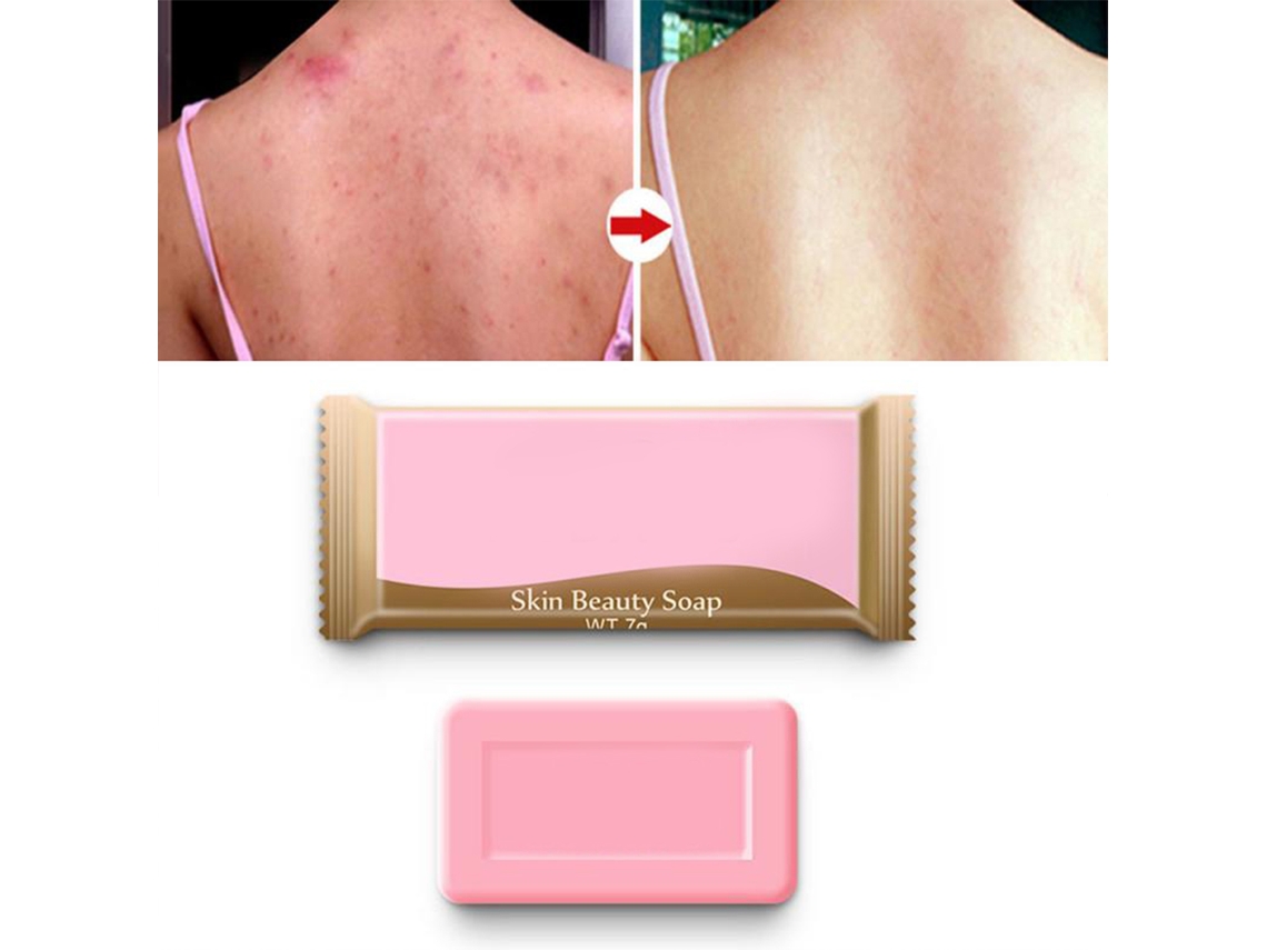 5 Peças De Sabonete De Banho De Enxofre Para Acne E Poros