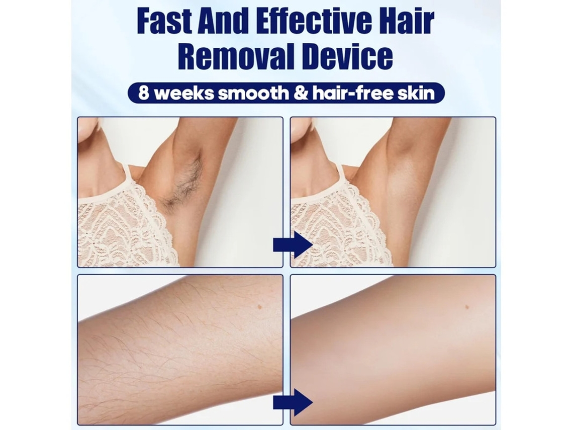 Depilador Facial Portátil Para Homens E Mulheres Sistema De Depilação Ice Atualizado Com Compressa De Gelo Branco Yizhood