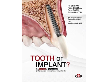 Livro Tooth or Implant de Unknown e Unknown (Inglês)