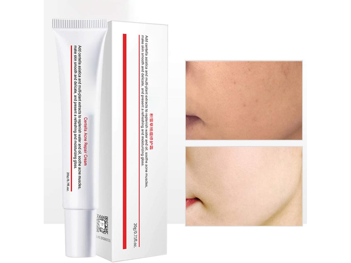 Crema Acné 20g: Elimina Rugas, Manchas E Manchas, Anti-imperfeições