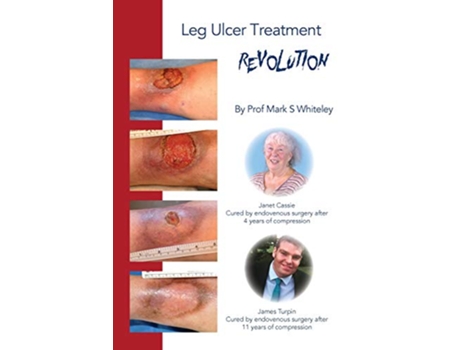 Livro Leg Ulcer Treatment Revolution de Mark S Whiteley (Inglês)