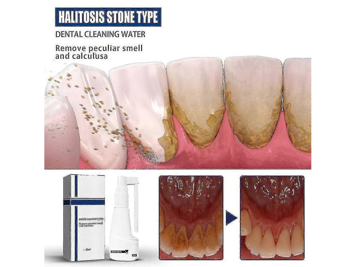 Spray De Solvente De Sarro Dental, Blanqueador Instantâneo, Limpeza Profunda, Remoção De Manchas, Fresco