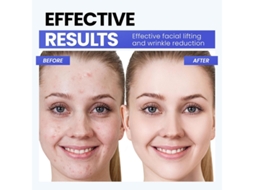 Dispositivo Facial De Microcorrente A Mais Recente Tecnologia De Luz Vermelha Recursos Aprimorados De Levantamento Facial E Endurecimento Yizhood