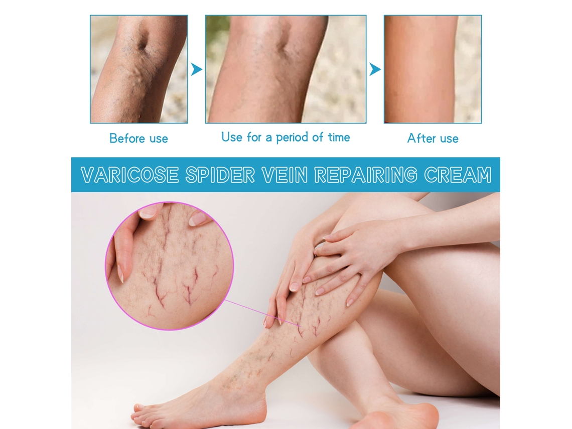 Creme Eficaz Para Tratamento E Reparo De Veias Varicosas