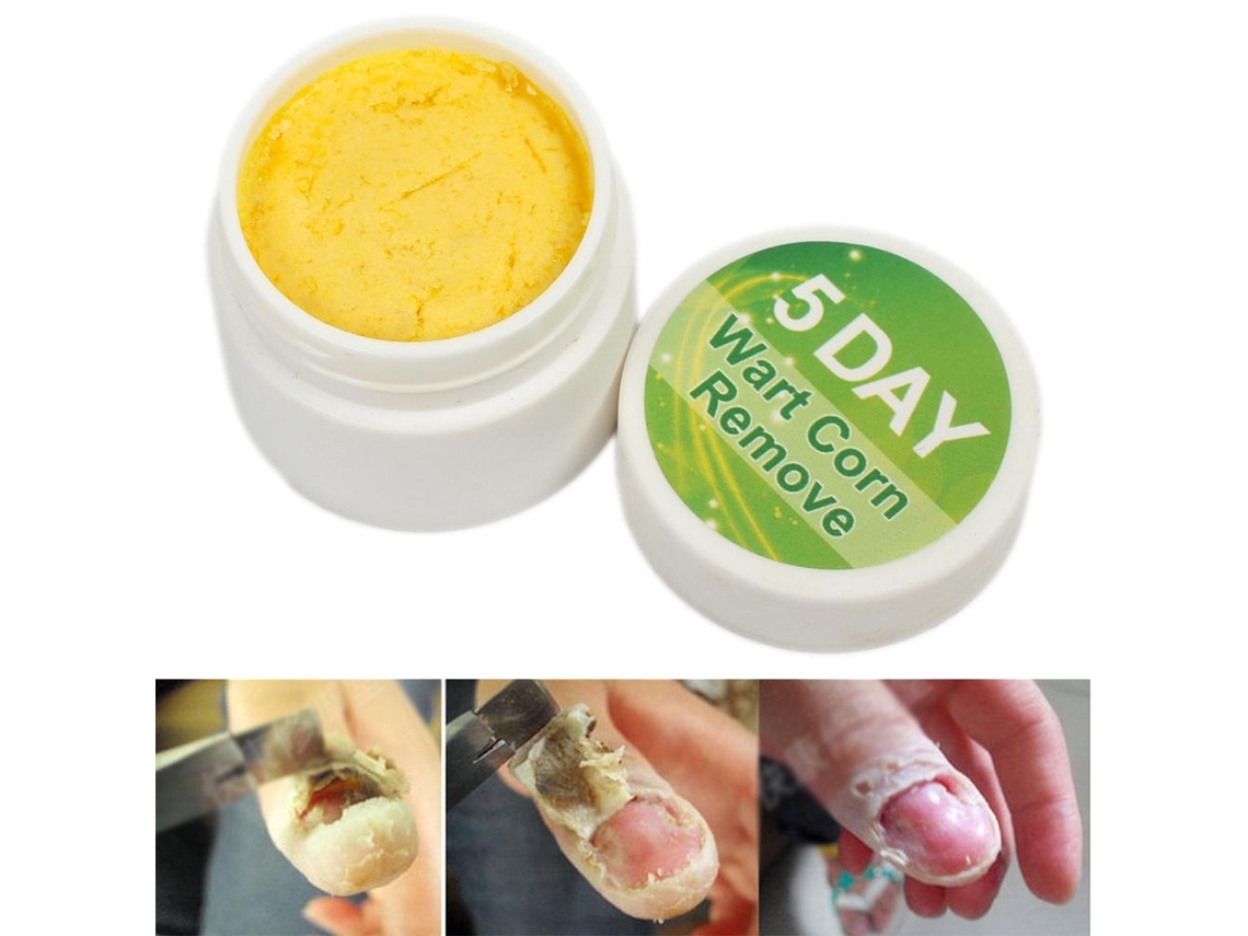 Creme Para Remoção De Fungos Nas Unhas, Creme De Reparação De Unhas