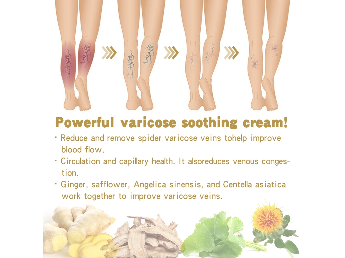Creme Para Varizes Ouhoe Trata Varizes E Alivia Desconforto