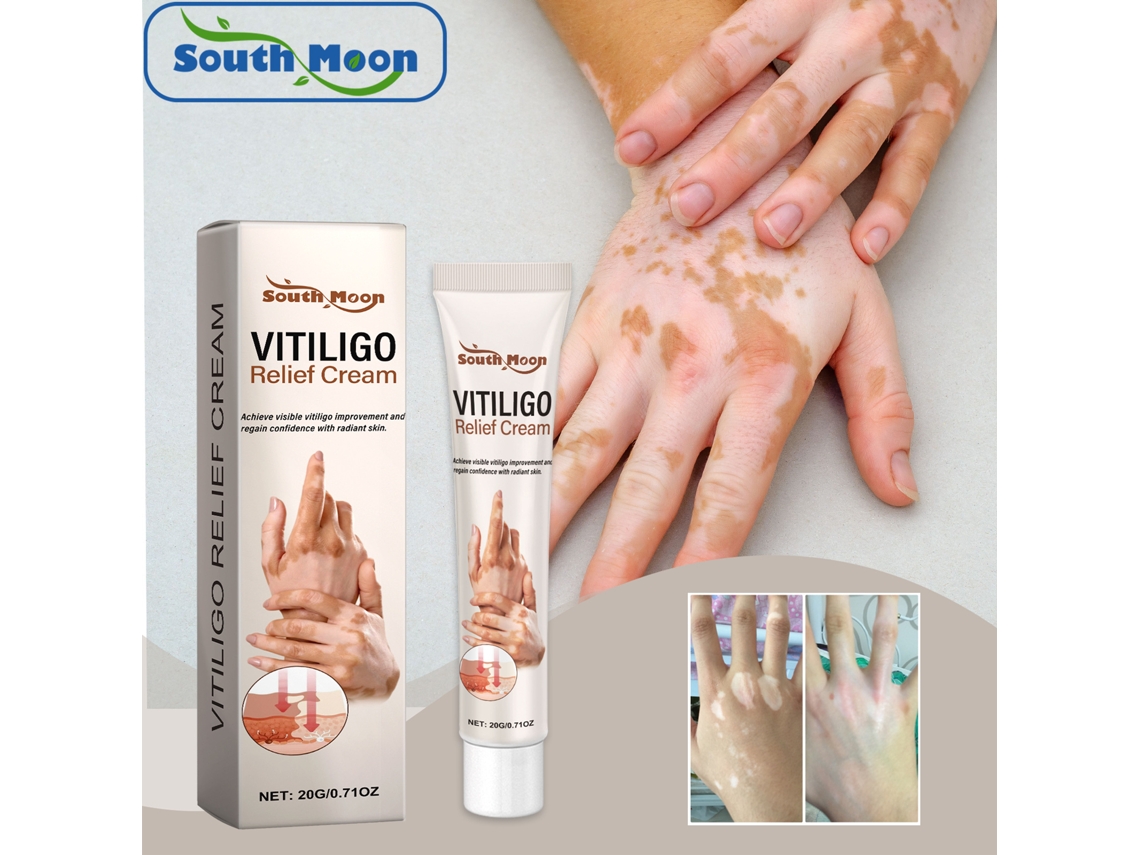 Creme Para Tratamento De Vitiligo, Alívio E Reparação De Manchas Brancas, Creme Para Leucoplasia E Estímulo Da Melanina Truyuety
