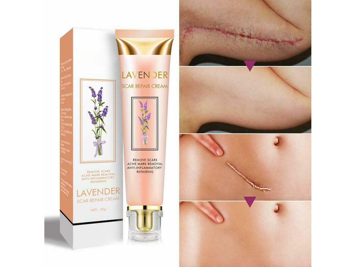 Creme Para Remoção De Cicatrizes De Acne E Marcas De Distensão