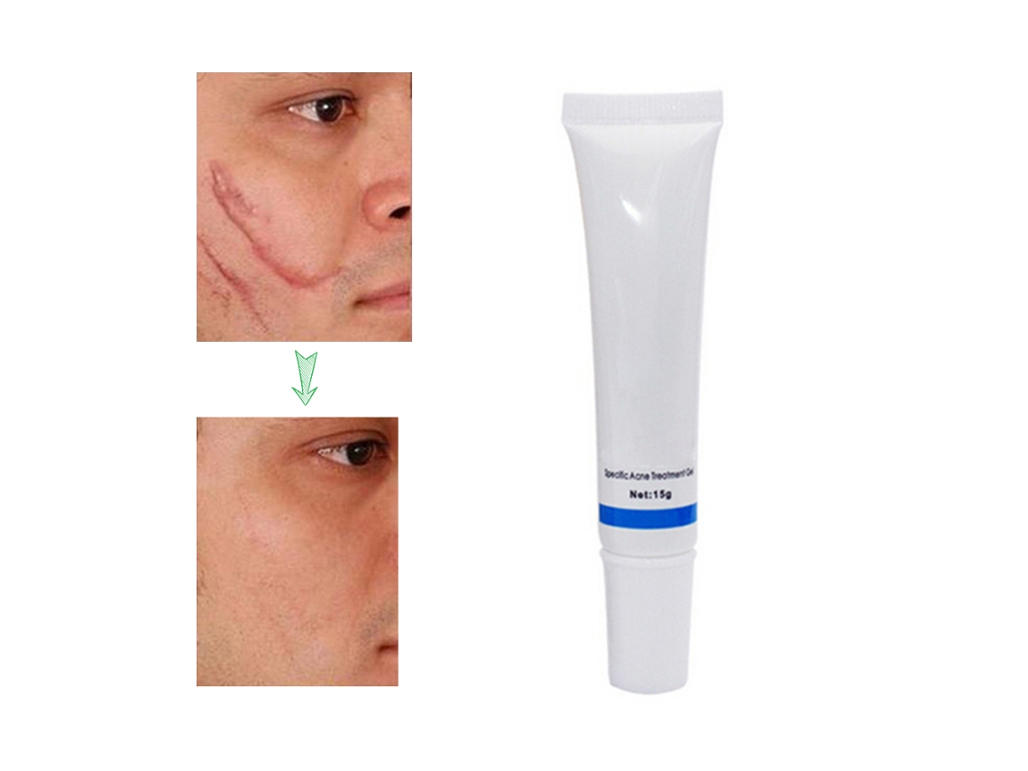 Creme Para Remover Cicatrizes Faciais 15g Para Manchas E Estrias Com Efeito De Reparo Forte