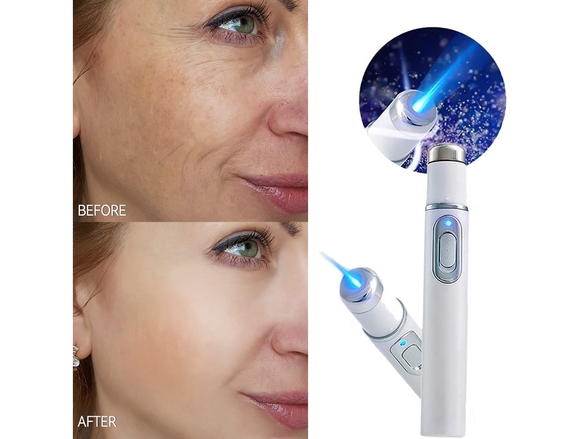 Caneta Laser Para Chrui Remoção De Acne E Rugas, Remoção De Manchas Na Pele, Terapia Com Luz Azul