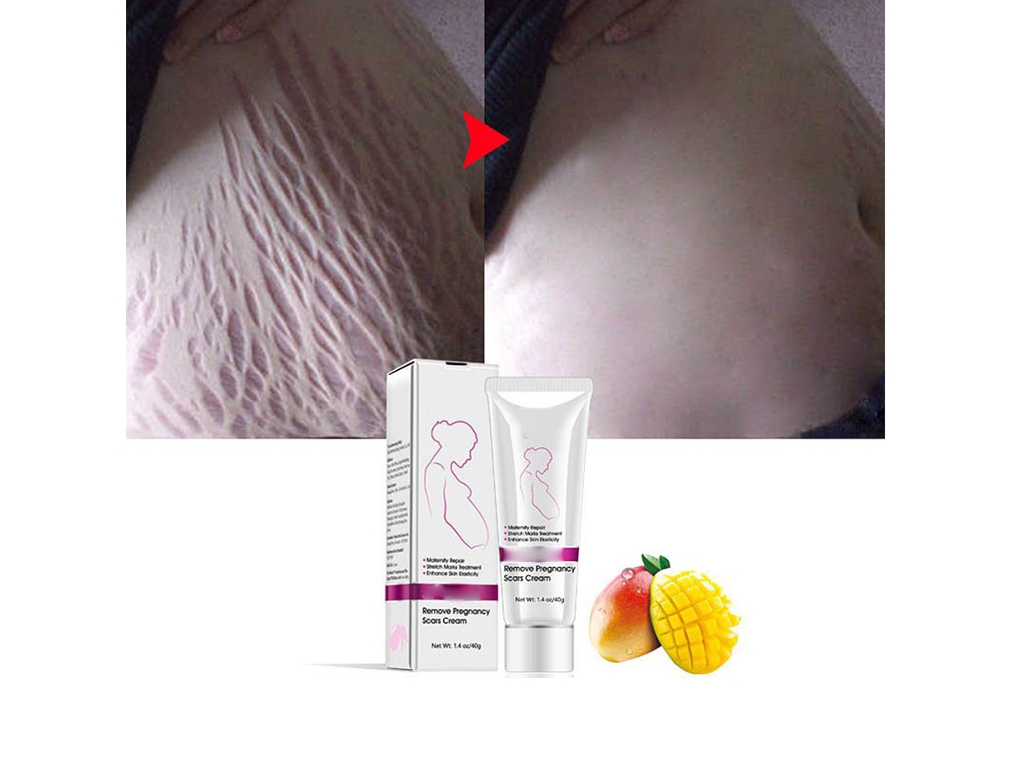 Creme Removedor De Cicatrizes De Acne E Tatuagens De Gravidez