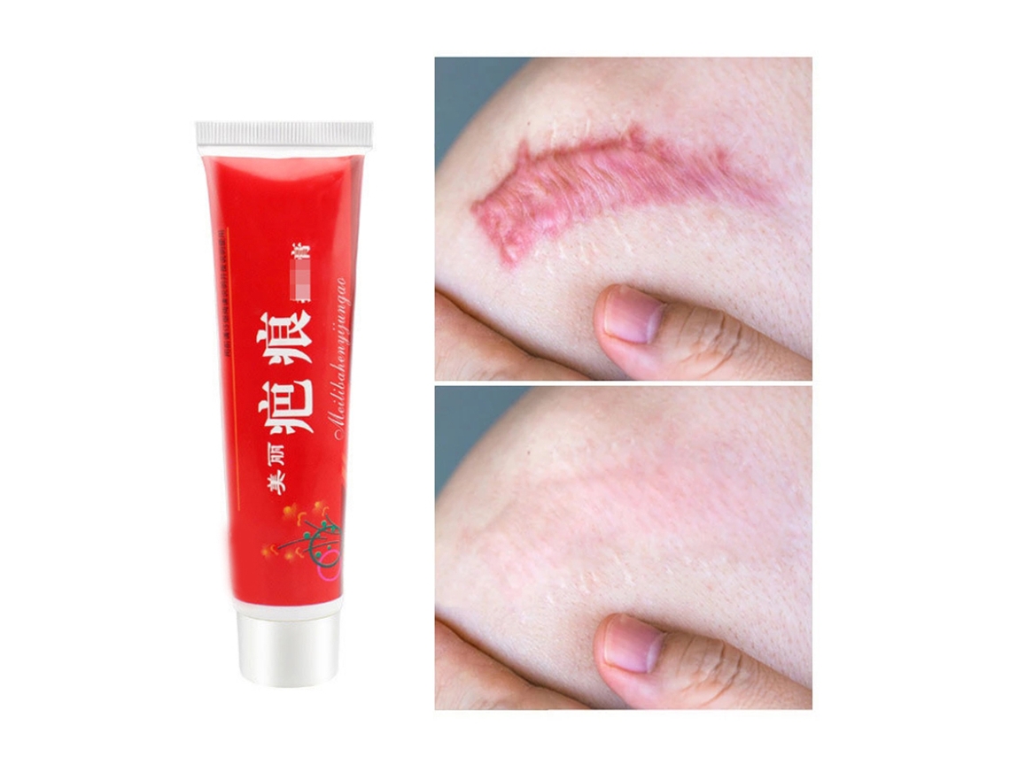 Creme Para Remoção De Cicatrizes De Acne E Alivio De Coceira