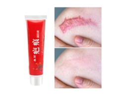 Creme Para Remoção De Cicatrizes De Acne E Alivio De Coceira