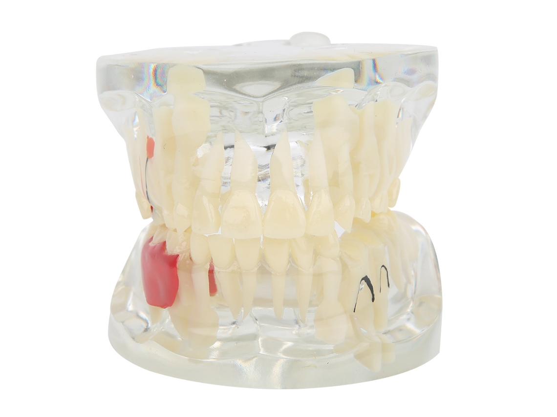 Modelo de Dentes Decíduos Patológicos para Ensino Odontológico Laboratório Hospital Instrumento Didático Resina Transparente