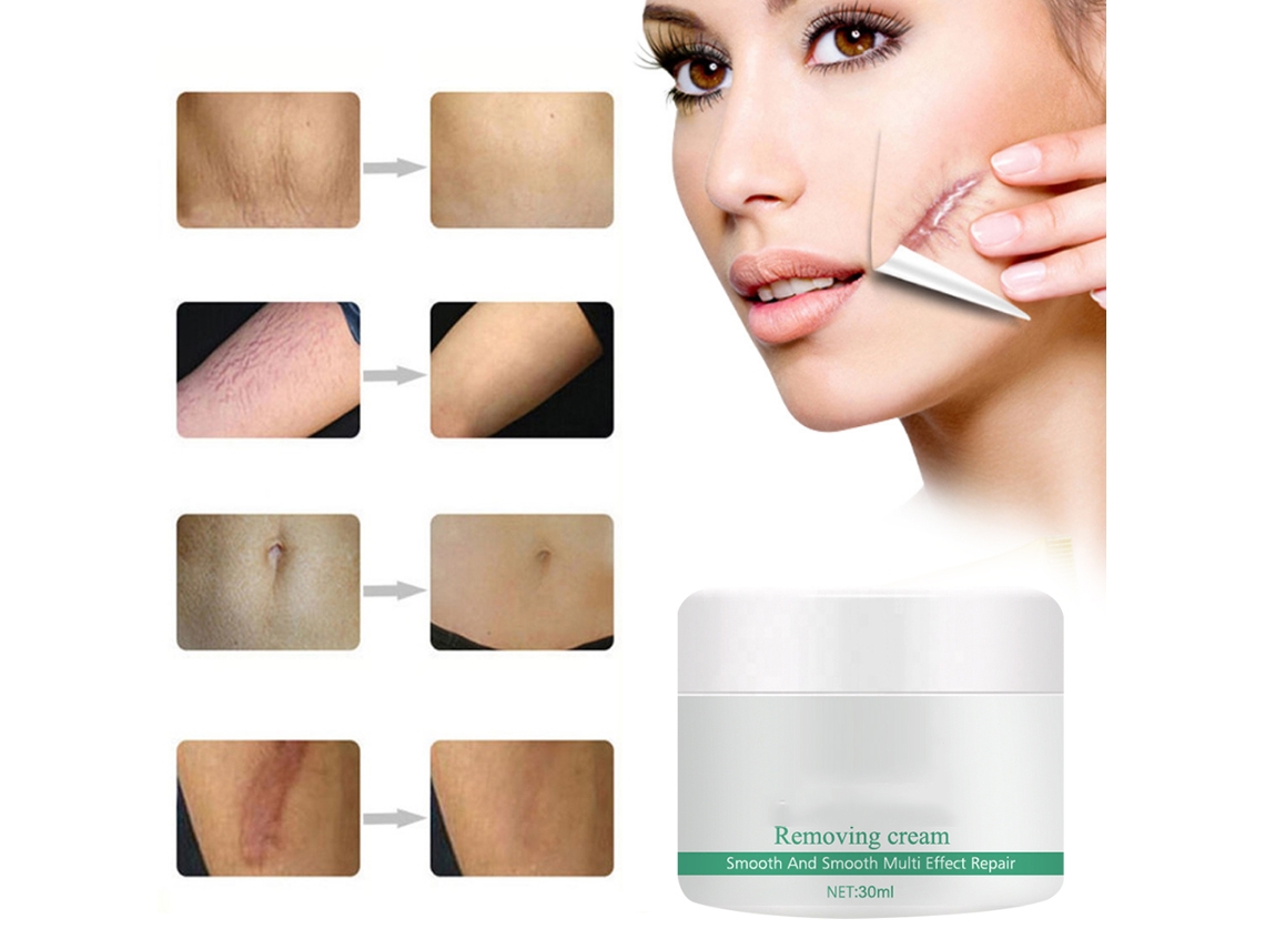 Creme Eficaz Para Remoção De Cicatrizes Antigas E Novas