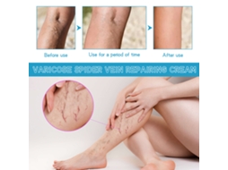 Creme Eficaz Para Tratamento E Reparo De Veias Varicosas