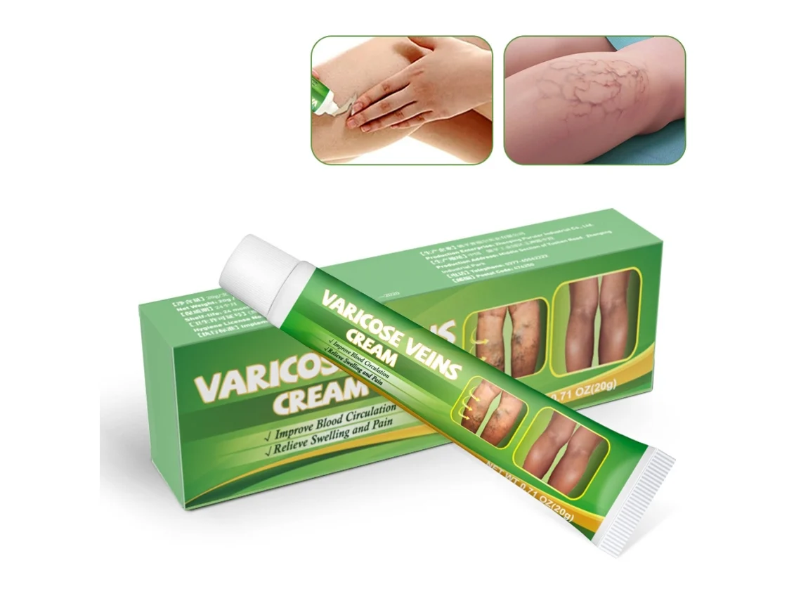Creme Para Varizes Remoção De Veias E Cuidado Com Inchaço