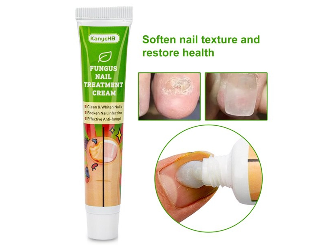 20G Tratamento de Unhas Unha Paroníquia Onicomicose Remoção Pomada Toe Care Emplastro Unha Fungal Solução para Toenai