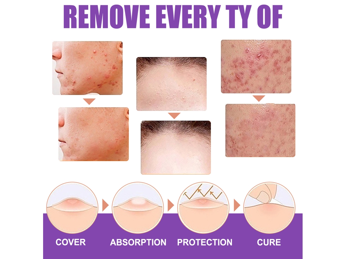 Líquido Para Eliminar Verrugas Y Etiquetas Cutáneas Eelhoe 30ml