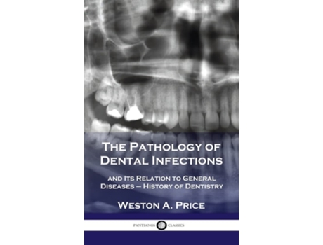 Livro Pathology of Dental Infections: and Its Relation to General Diseases - History of Dentistry de Weston a. Price (Inglês)