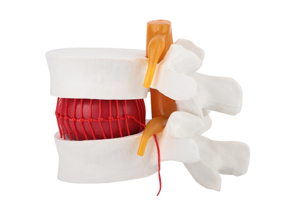 Modelo De Hérnia De Disco Lombar Humano Para Ensino Médico 1:1.5