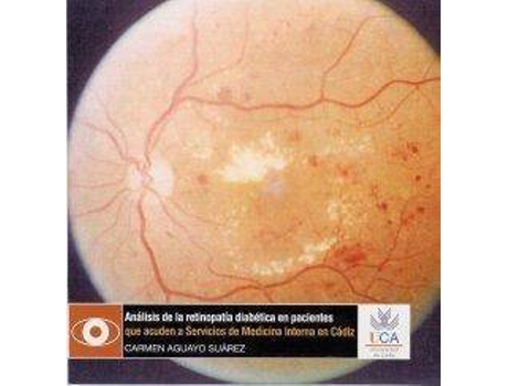 Audio-Livro Análisis De La Retinopatía Diabética En Pacientes Que Acuden A Servicios De Medicina Interna En Cádiz de Carmen Aguayo Suárez (Espanhol)
