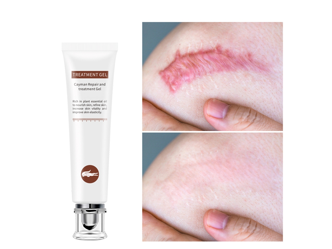Creme Para Cicatrizes E Marcas De Estirpe Não Irritante