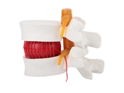Modelo De Hérnia De Disco Lombar Humano Para Ensino Médico 1:1.5