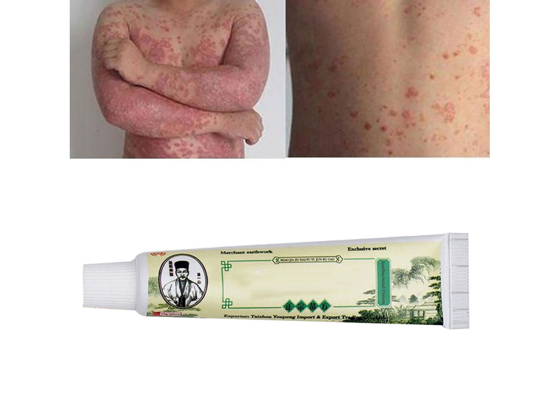 Creme Para Pele (tratamento De Psoríase E Alívio De Prurido)